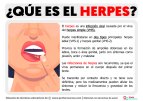 Que-es-un-Herpes.jpg